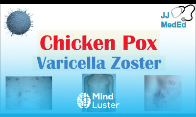 Chickenpox Varicella Zoster Virus Pathogenesis Signs and Symptoms Diagnosis and Treatment