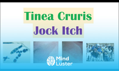 Jock Itch Tinea Cruris Causes Risk Factors Signs Symptoms Diagnosis and Treatment