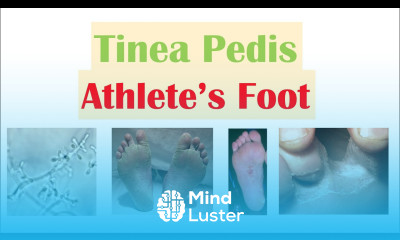 Athlete s Foot Tinea Pedis Causes Risk Factors Signs Symptoms Diagnosis and Treatment