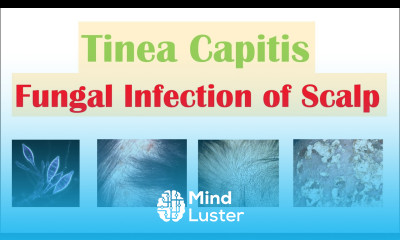 Fungal Infection of the Scalp Tinea Capitis Causes Risk Factors Symptoms Diagnosis Treatment