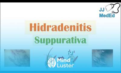 Hidradenitis Suppurativa HS Pathophysiology Triggers Signs Symptoms Diagnosis Treatment