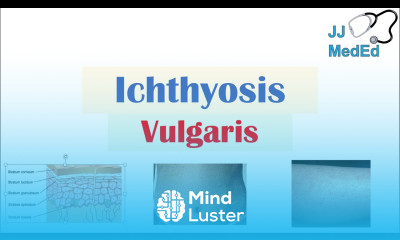 Ichthyosis Vulgaris Causes Signs Symptoms Diagnosis Treatment