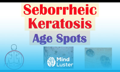 Seborrheic Keratosis “Age Spots” Risk Factors Causes Skin Lesions Diagnosis Treatment