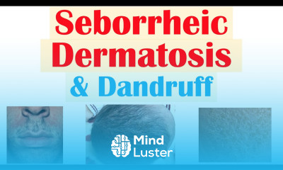 Seborrheic Dermatitis Dandruff and Cradle Cap Causes Risk Factors Symptoms Diagnosis Treatment