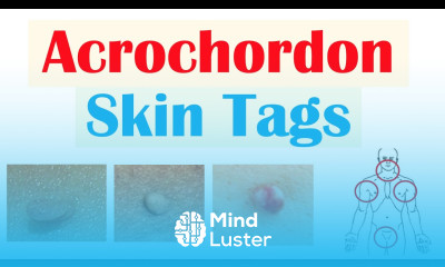Skin Tags Acrochordons Causes Risk Factors Symptoms Diagnosis Treatment