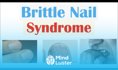 Brittle Nail Syndrome Causes Signs Symptoms Diagnosis Treatment Supplements