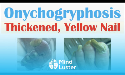 Onychogryphosis Thickened Yellow Nails Causes Signs Symptoms Diagnosis Treatment