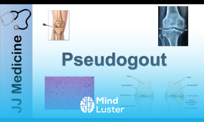 Pseudogout Pathophysiology Symptoms and Treatment