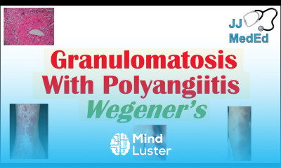 Granulomatosis with Polyangiitis Wegener s granulomatosis Symptoms Diagnosis Treatment