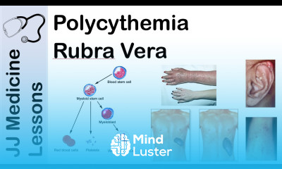 Polycythemia Rubra Vera Pathophysiology Symptoms Diagnosis and Treatment