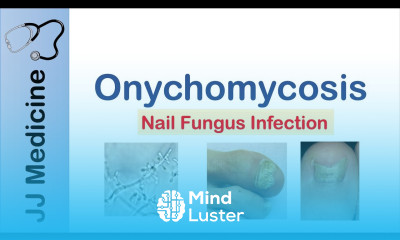 Onychomycosis Nail Infection Signs Symptoms Treatment