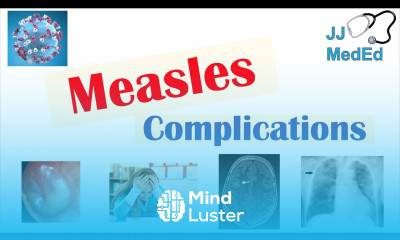 Measles Complications Immunosuppression Encephalitis SSPE etc Diagnosis Treatment Prevention