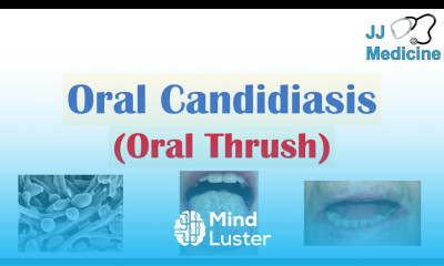 Oral Candidiasis Oral Thrush Causes Pathophysiology Signs Symptoms Diagnosis Treatment
