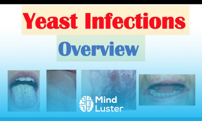 Candidal Yeast Infections Overview Oral Thrush Vaginal Intertrigo Esophageal Candidiasis