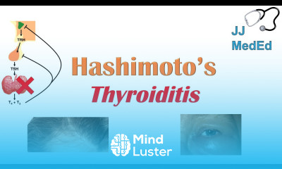 Hashimoto s thyroiditis What Is It Who s At Risk and What You NEED to Know
