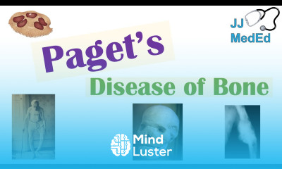 Paget s Disease of Bone Osteitis Deformans Causes Pathogenesis Symptoms Diagnosis Treatment