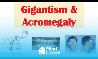 Gigantism Acromegaly Growth Hormone Signs Symptoms Diagnosis Treatment