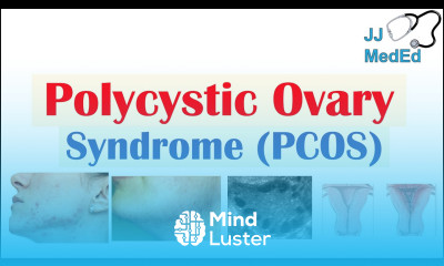Polycystic Ovary Syndrome PCOS Causes Risks and Treatments