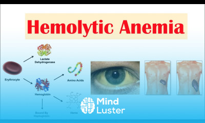 Hemolytic Anemia