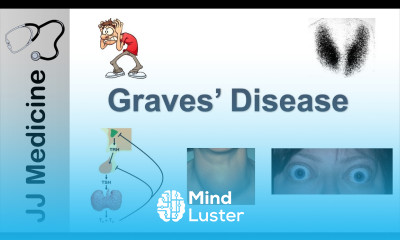 Graves Disease and Graves Ophthalmopathy Signs Symptoms Diagnosis and Treatment