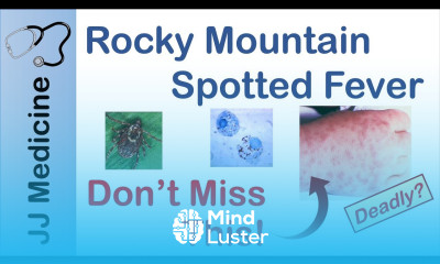 Rocky Mountain Spotted Fever Bacteria Signs Symptoms Diagnosis and Treatment