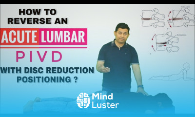 SELF TREATMENT OF ACUTE LUMBAR DISC PROLAPSE Sciatica USING DISC REDUCTION POSITIONING