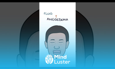 Causes of Angioedema medicine immunology dermatology