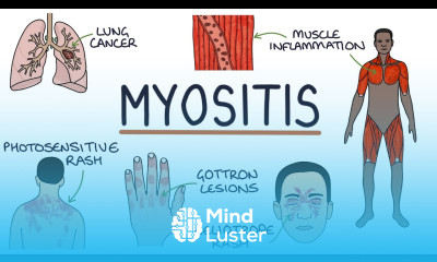Understanding Myositis Polymyositis and Dermatomyositis