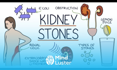 Understanding Kidney Stones
