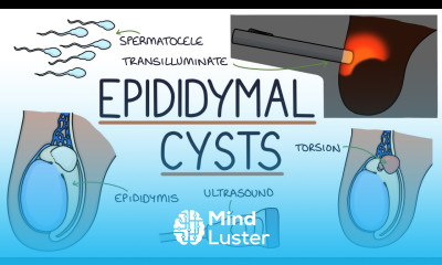 Understanding Epididymal Cysts