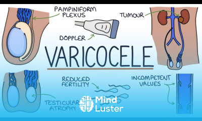 Varicoceles