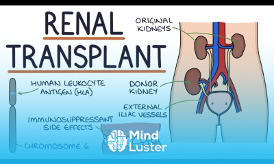 Understanding Kidney Transplants