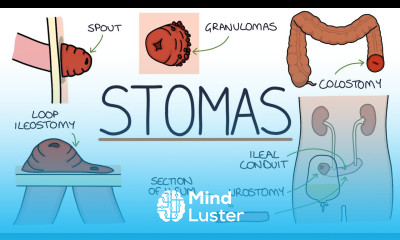 Understanding Stomas Colostomy Ileostomy Urostomy and Gastrostomy
