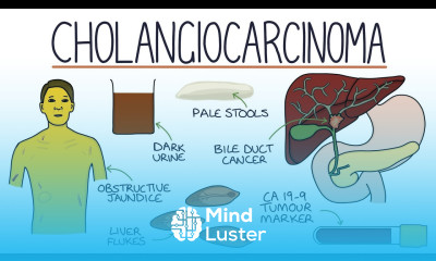 Understanding Cholangiocarcinoma