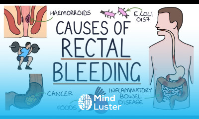 Understanding the Causes of Blood in Stool Rectal Bleeding