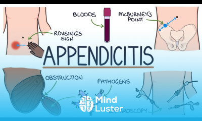 Understanding Appendicitis