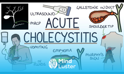 Understanding Acute Cholecystitis