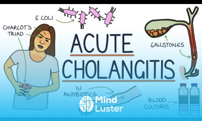 Understanding Acute Cholangitis Ascending Cholangitis
