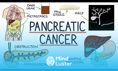 Understanding Pancreatic Cancer