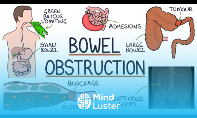 Understanding Bowel Obstruction