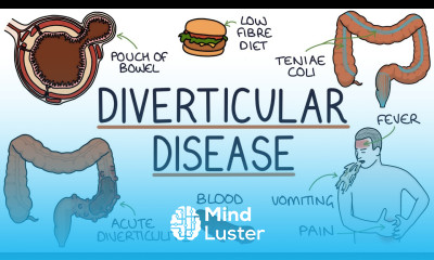 Understanding Diverticulosis and Diverticulitis