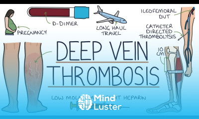 Understanding Deep Vein Thrombosis DVT