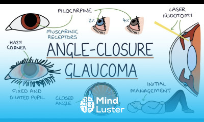 Understanding Acute Angle Closure Glaucoma