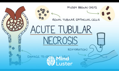 Understanding Acute Tubular Necrosis
