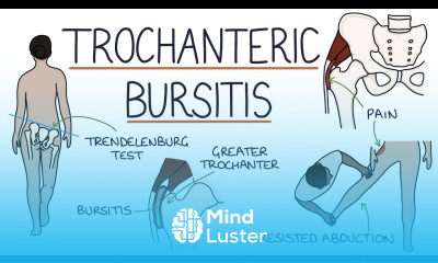Understanding Trochanteric Bursitis
