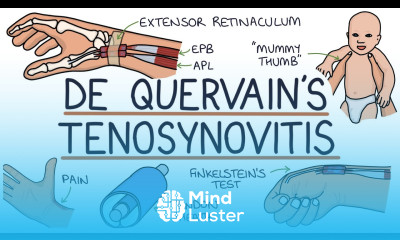 Understanding De Quervain s Tenosynovitis Mummy Thumb