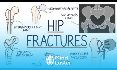 Understanding Hip Fractures and Hip Surgery