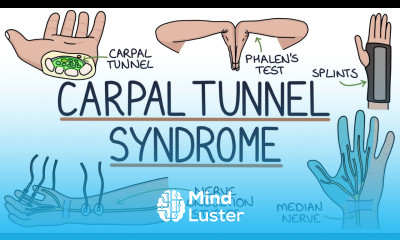 Understanding Carpal Tunnel Syndrome
