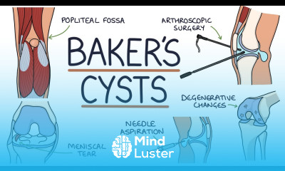 Understanding Baker s Cysts Popliteal Cysts