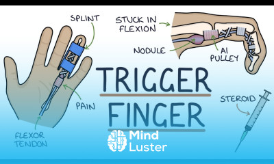 Understanding Trigger Finger Stenosing Tenosynovitis